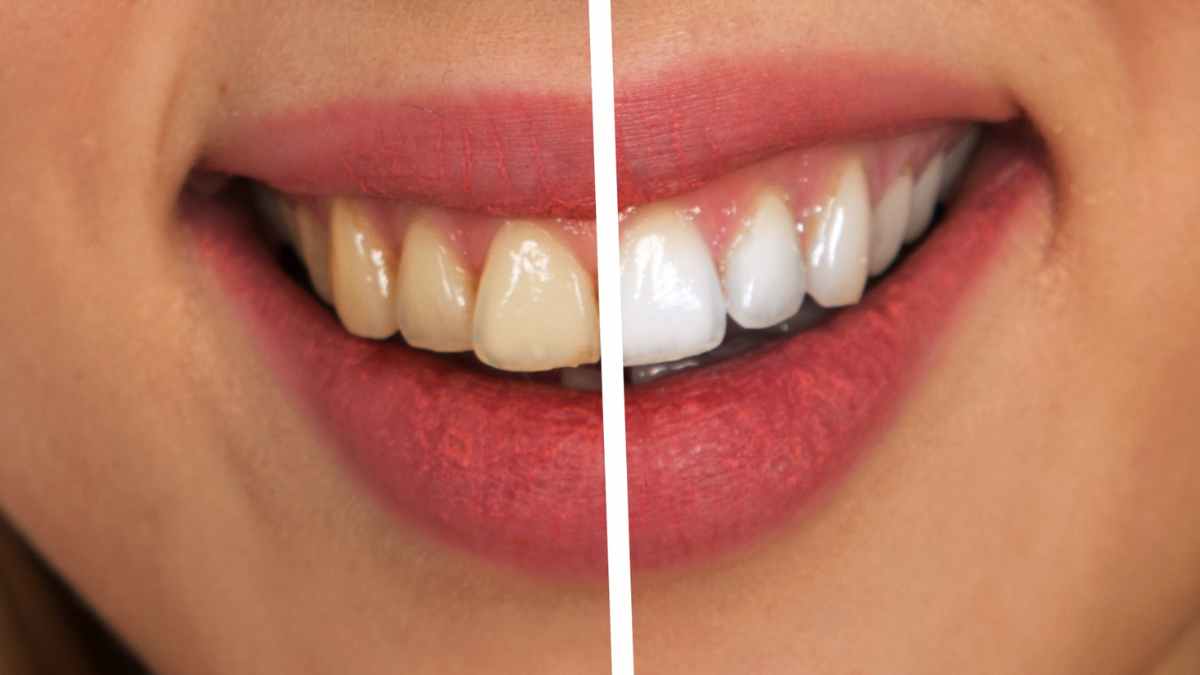 Antes y después de eliminar el sarro dental con remedio casero natural de limón