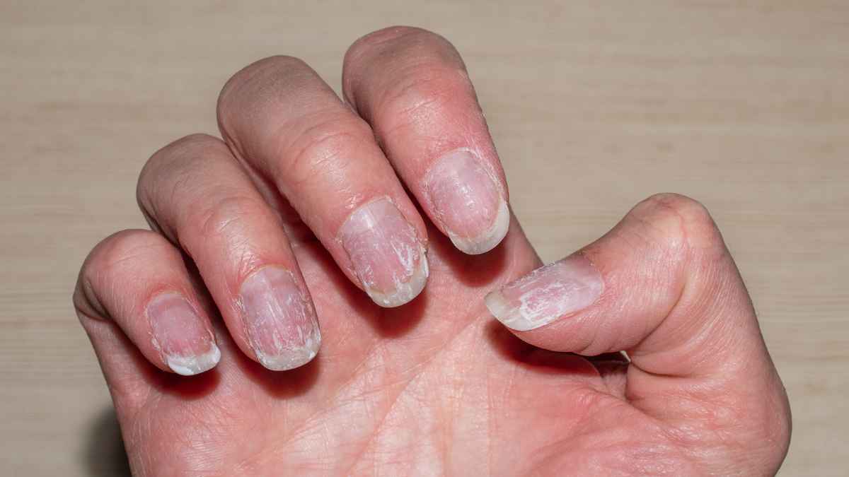 Rayas blancas en las uñas: ¿Por qué aparecen? Esto es lo que tu cuerpo quiere decirte