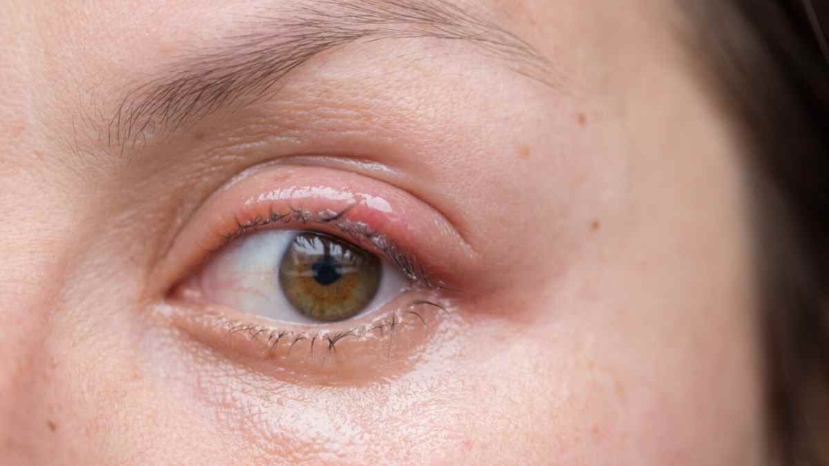 Ojo con orzuelo inflamado en el párpado superior, problema común tras los 40 al no usar gafas de cerca.