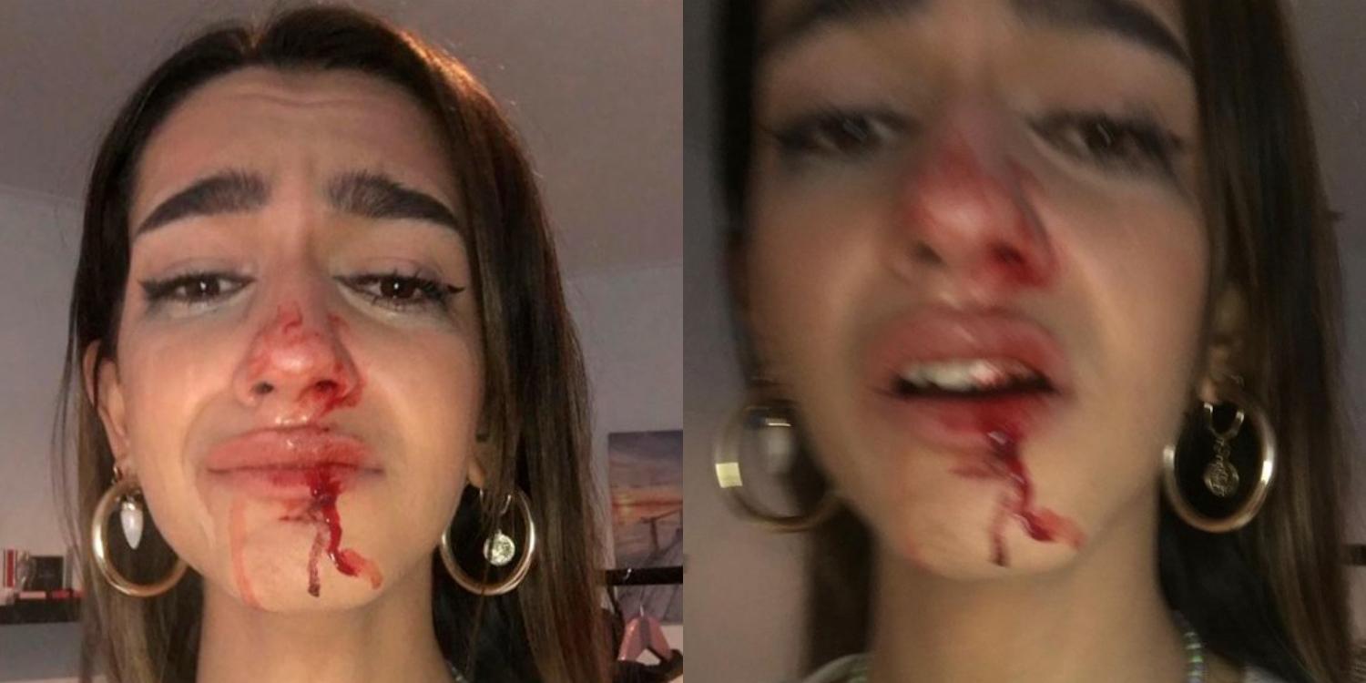 El rostro de Eva Vildosola después de la agresión. Fuente: Instagram.