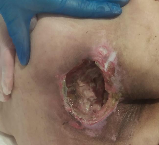 Úlcera en el sacro en el momento del ingreso en el hospital
