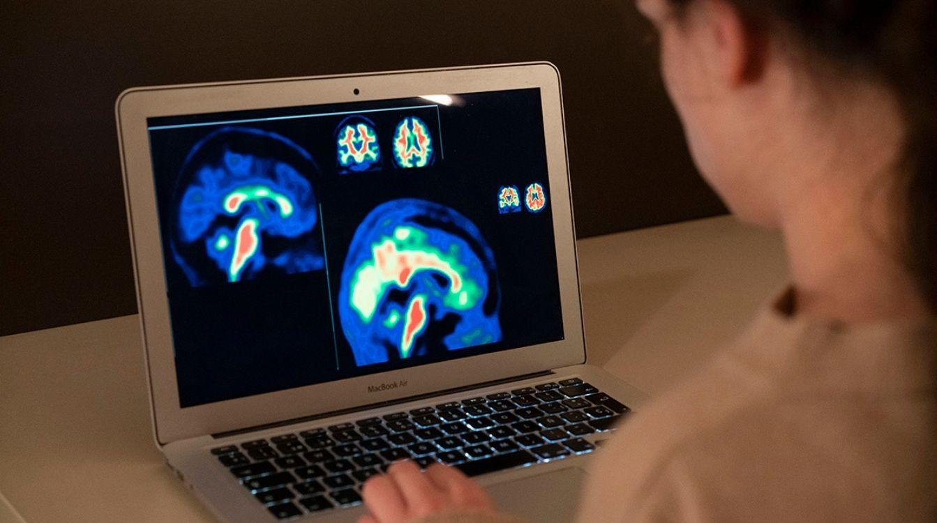 Investigadores europeos mejoran la sensibilidad del diagnóstico de las fases iniciales del alzhéimer
