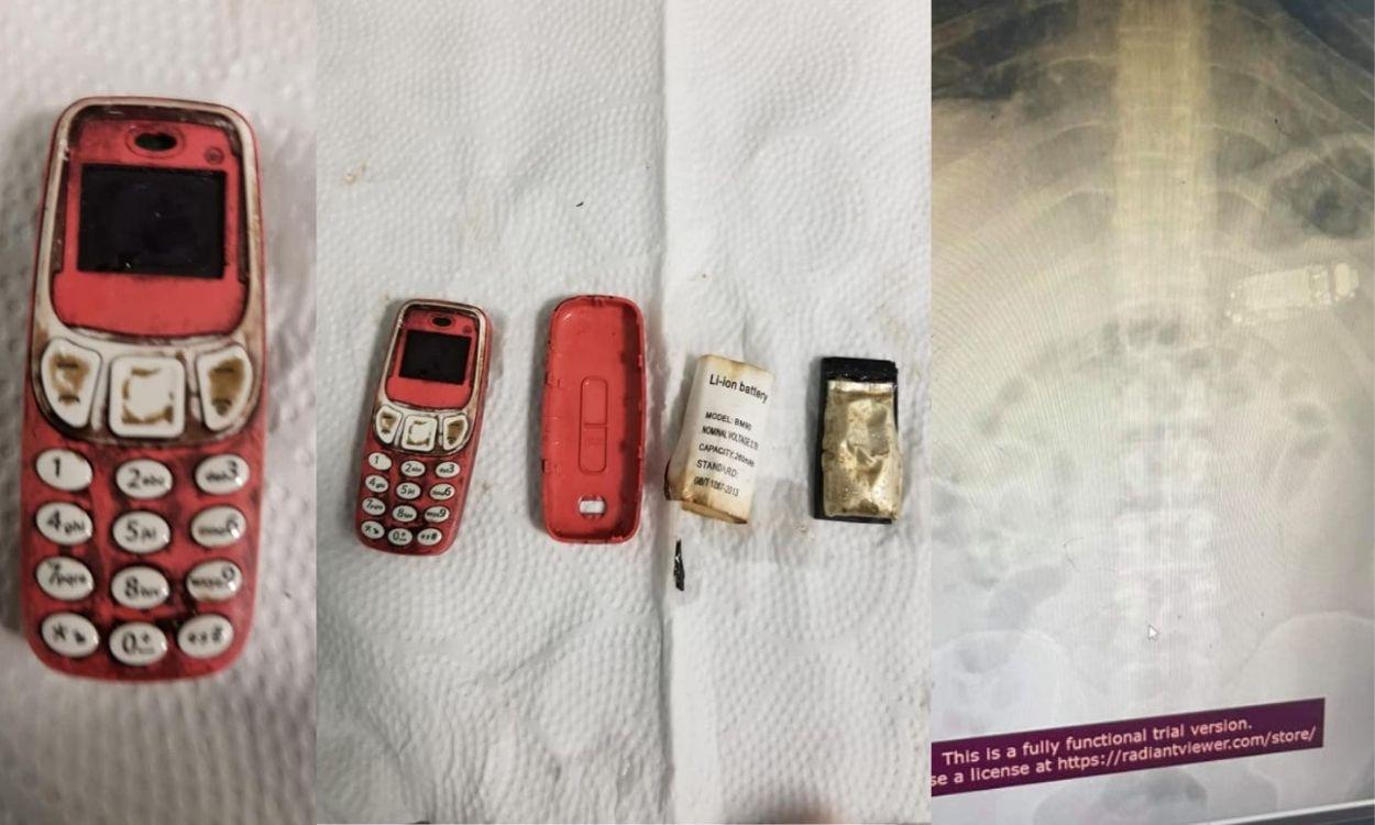 El Nokia 3310 que había ingerido el paciente  - Facebook