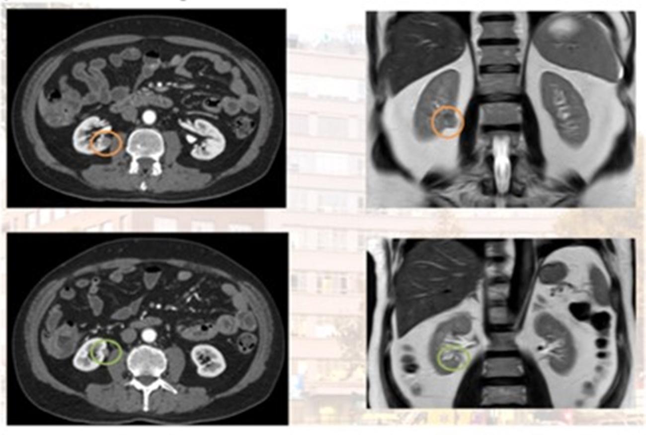 Imagen en la que se aprecian dos pequeñas neoplasias renales. (Foto: FJD)