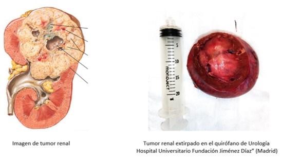 Tumor renal