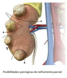 Nefrectomía parcial