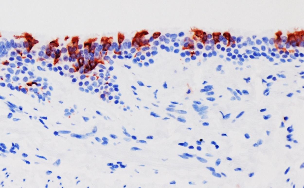 La variante omicrón del SARS CoV 2 (en rojo) infectando tejidos de bronquios humanos. Universidad de Hong Kong