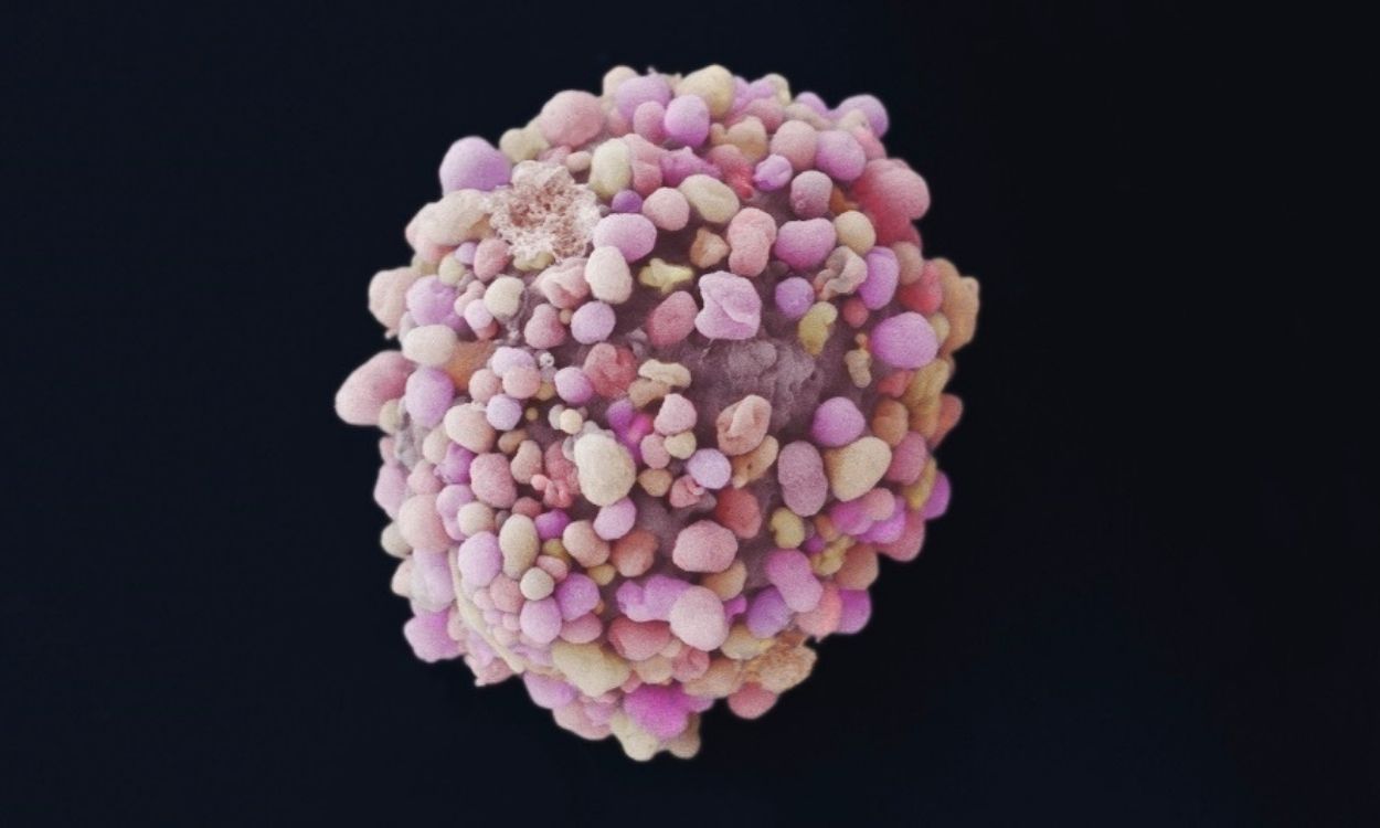 Célula de cáncer de mama. EP