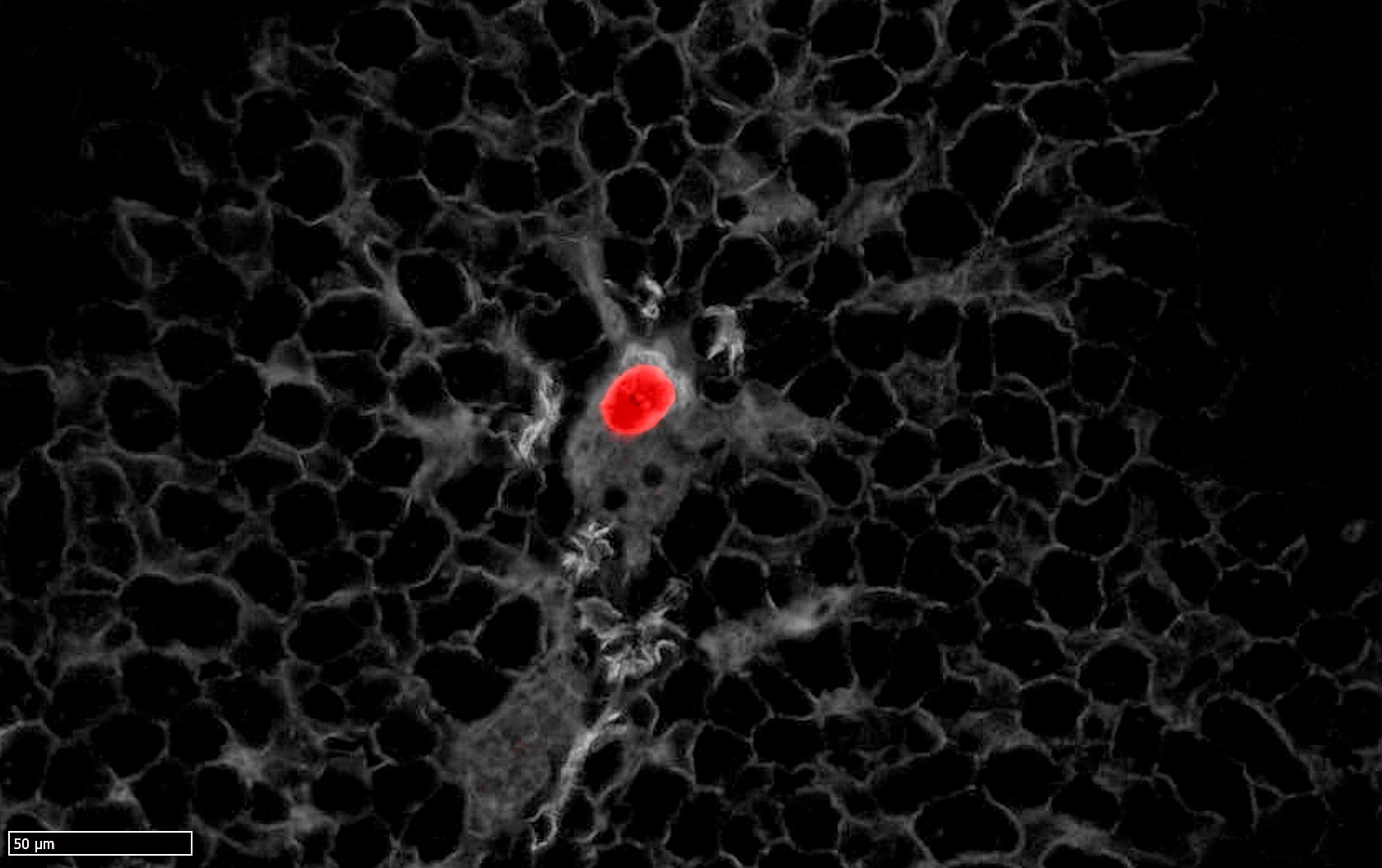 Imagen de una célula tumoral que causa metástasis en los pacientes de cáncer de colon. EP.