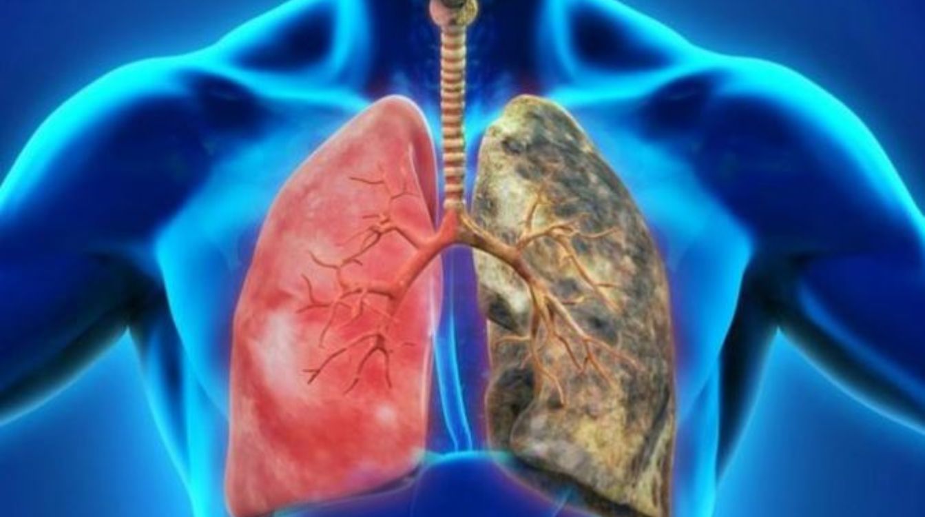 El enfisema pulmonar es una de las enfermedades asociadas a la EPOC y destruye progresivamente las fibras que permiten que las vías respiratorias permanezcan abiertas