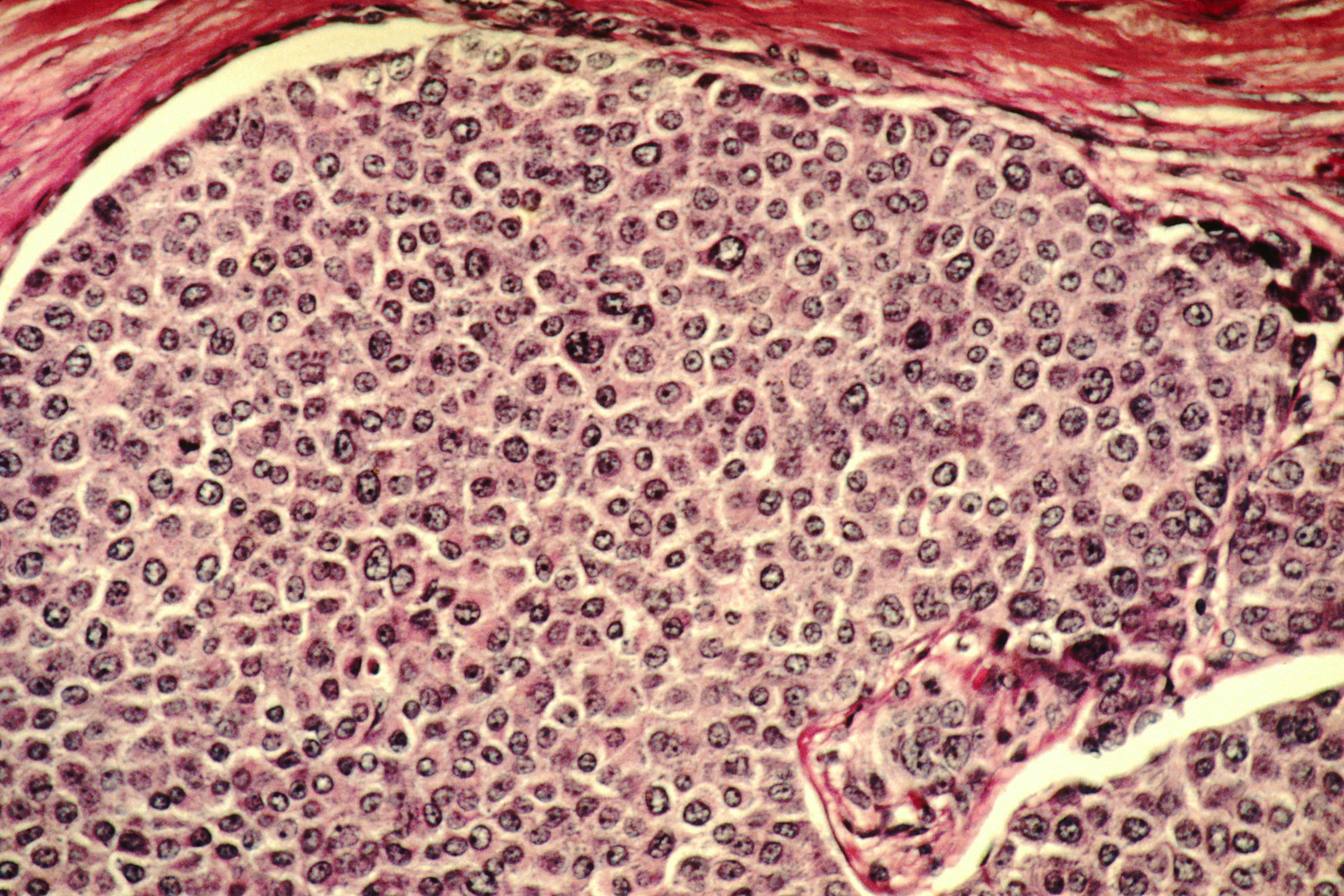 Hay un nutriente que anhelan las células cancerosas y que puede ser una solución para acabar con ellas 