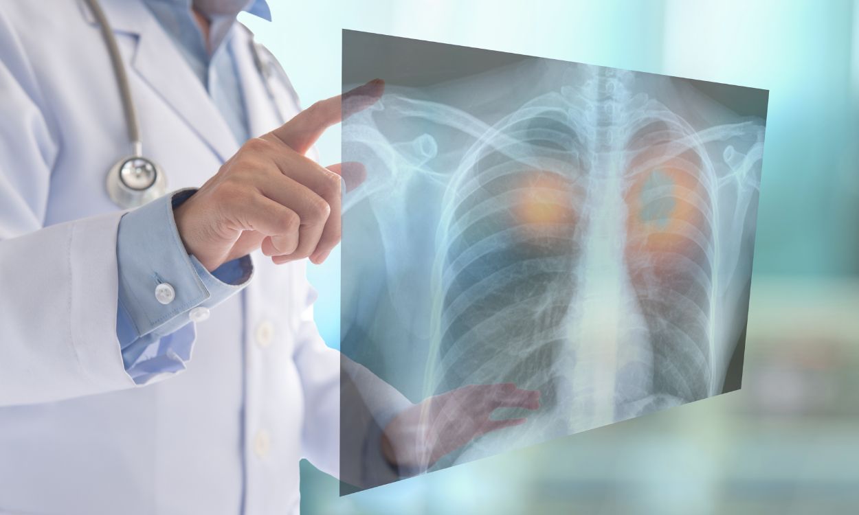 La inmunoterapia ha mejorado notablemente la supervivencia de los pacientes con cáncer de pulmón