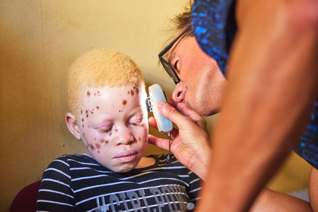 Dermatólogos de diferentes países se desplazan a Mozambique para ayudar a las personas con albinismo a combatir el cáncer de piel. (Foto: ISDIN/Laura Ponce)