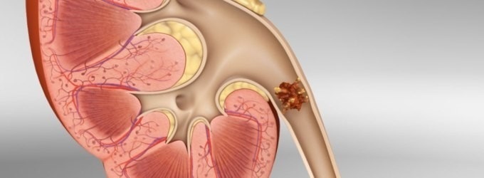 Cálculo renal. EuropaPress 