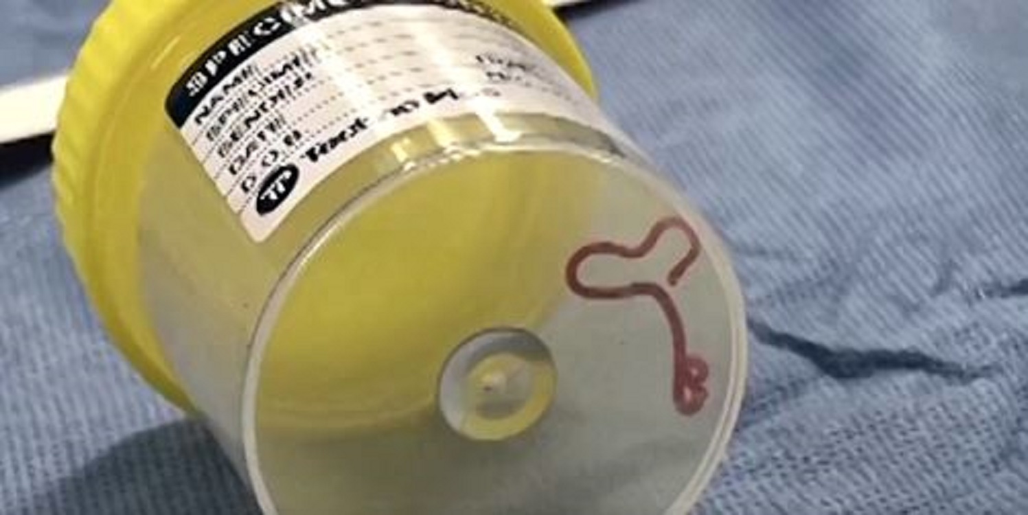 Extraen un gusano de hasta ocho centímetros del cerebro de una mujer en Australia. Twitter 