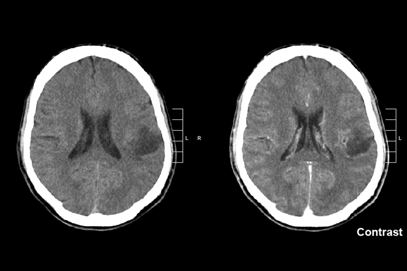 Glioma en el lóbulo parietal izquierdo. Imagen de Mikhail Kalinin 