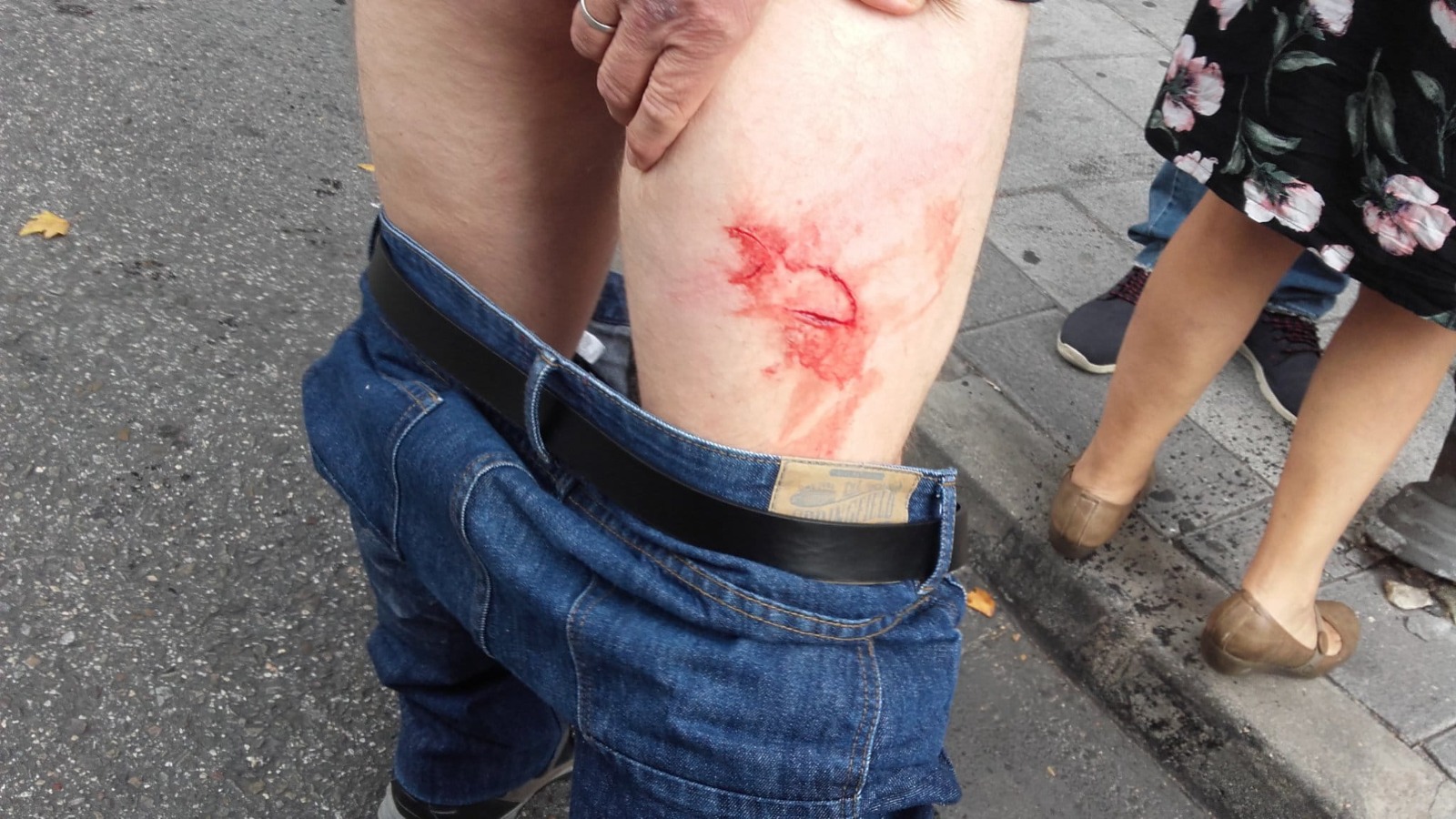 Lesiones sufridas por los manifestantes tras las cargas policiales.