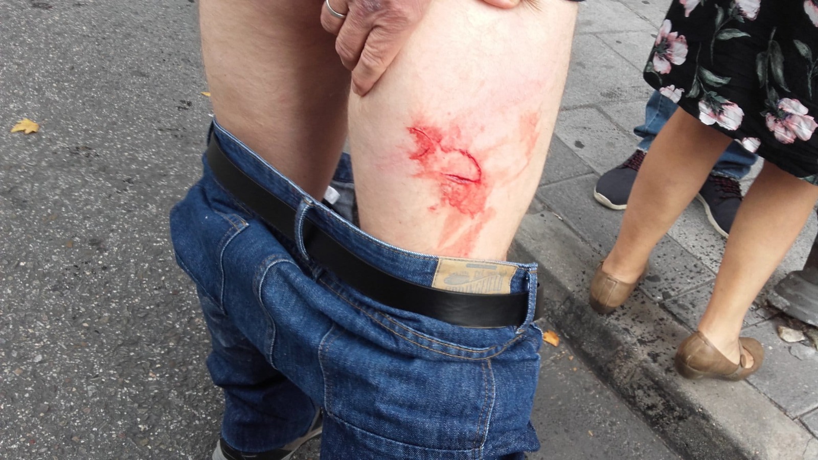Lesiones sufridas por los manifestantes tras las cargas policiales. Lesiones sufridas por los manifestantes tras las cargas policiales.