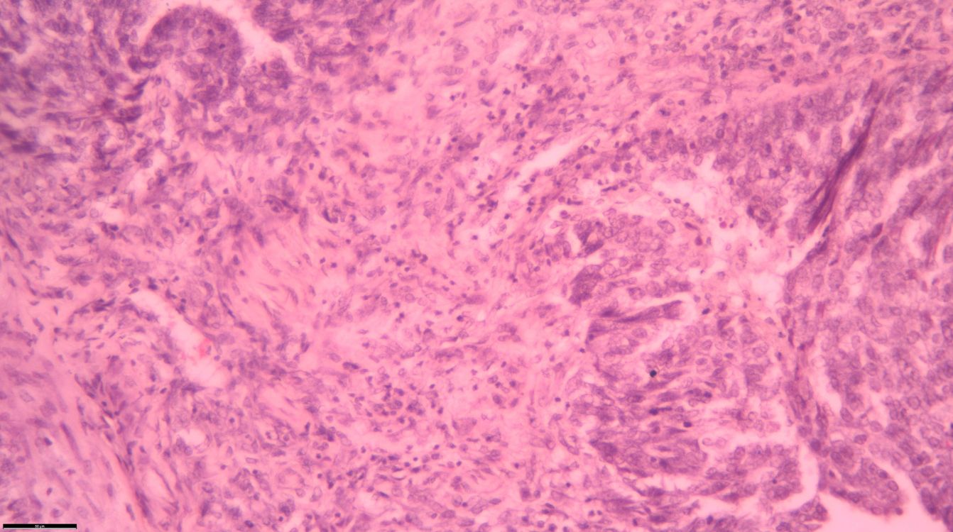 Muestras de un tumor de hígado vistas gracias a la nueva plataforma Unique CaixaResearch. © VHIO