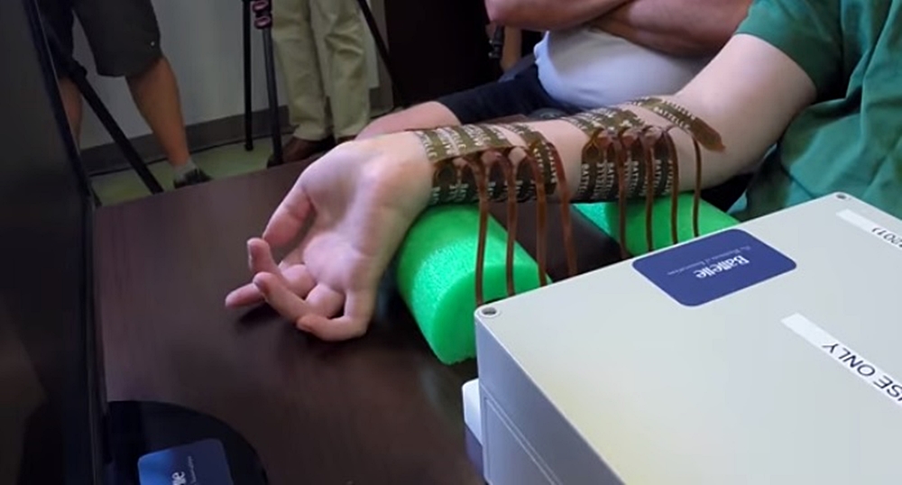 El brazo de Ian Burkhart con esa especie de manga conectada a su cerebro.