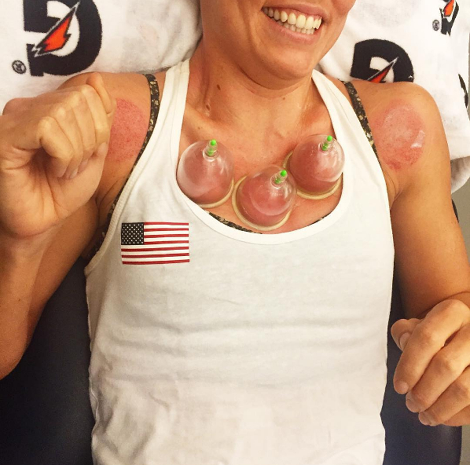 La atleta estadounidense Natalie Coughlin aplicándose 'cupping'