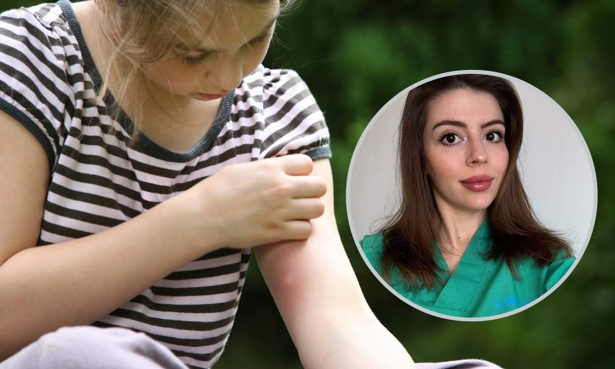 Los consejos de Marta Díez, enfermera dermoestética, para las picaduras de mosquitos