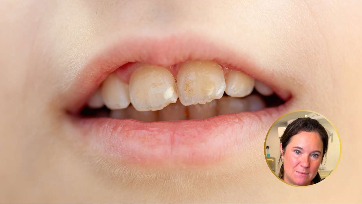 Manchas blancas en los dientes las tres causas más comunes según una ortodoncista