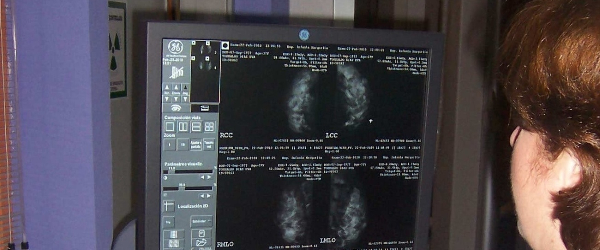 La Federación Española de Cáncer de mama exige respuestas inmediatas al problema de las mamografías de Andalucía