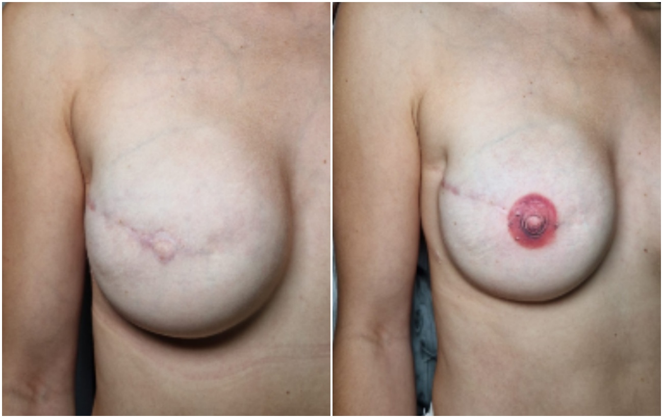 Mama con y sin micropigmentación areolar. (Foto: Rafa Garabal)