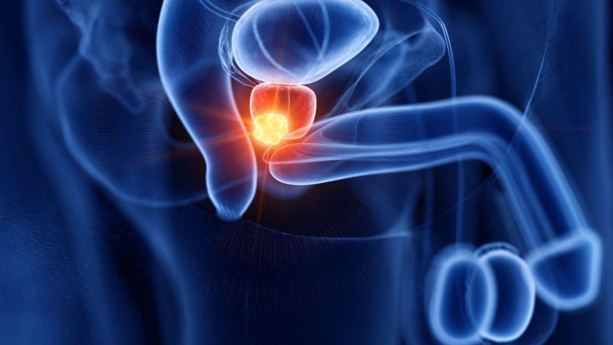 Nuevos datos de ASCO 2026 respaldan la eficacia de la terapia con radioligandos en cáncer de próstata metastásico sensible al tratamiento hormonal.