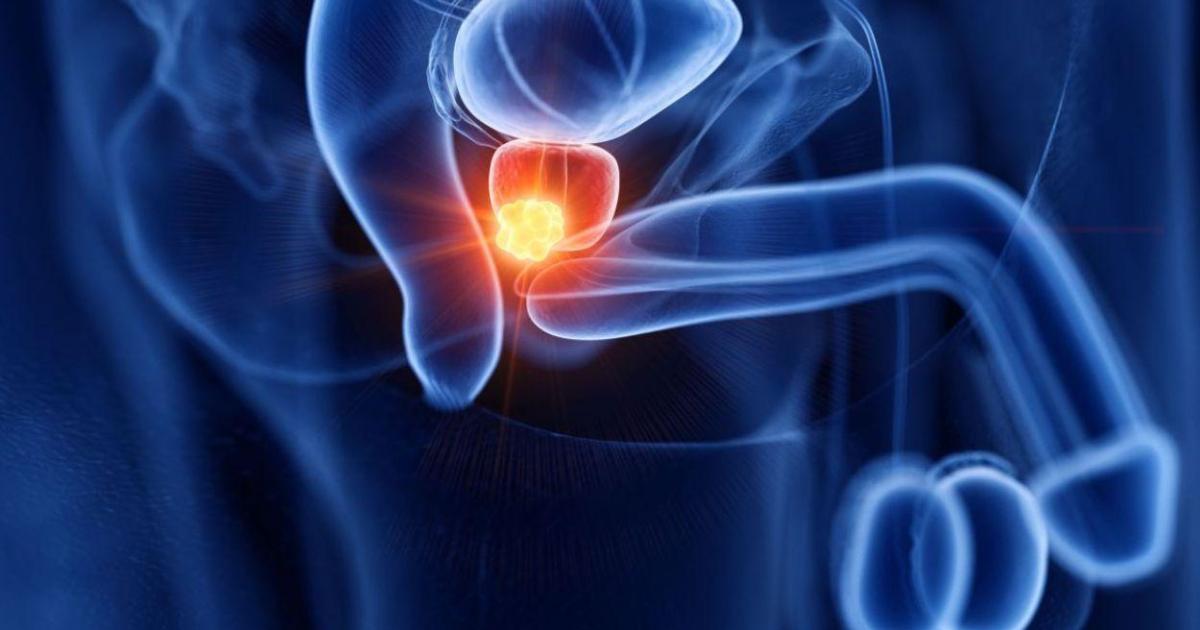 Nuevos datos de ASCO 2026 respaldan la eficacia de la terapia con radioligandos en cáncer de próstata metastásico sensible al tratamiento hormonal