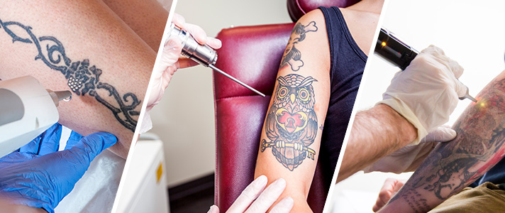 Tatuajes: eliminarlos con garantías médicas