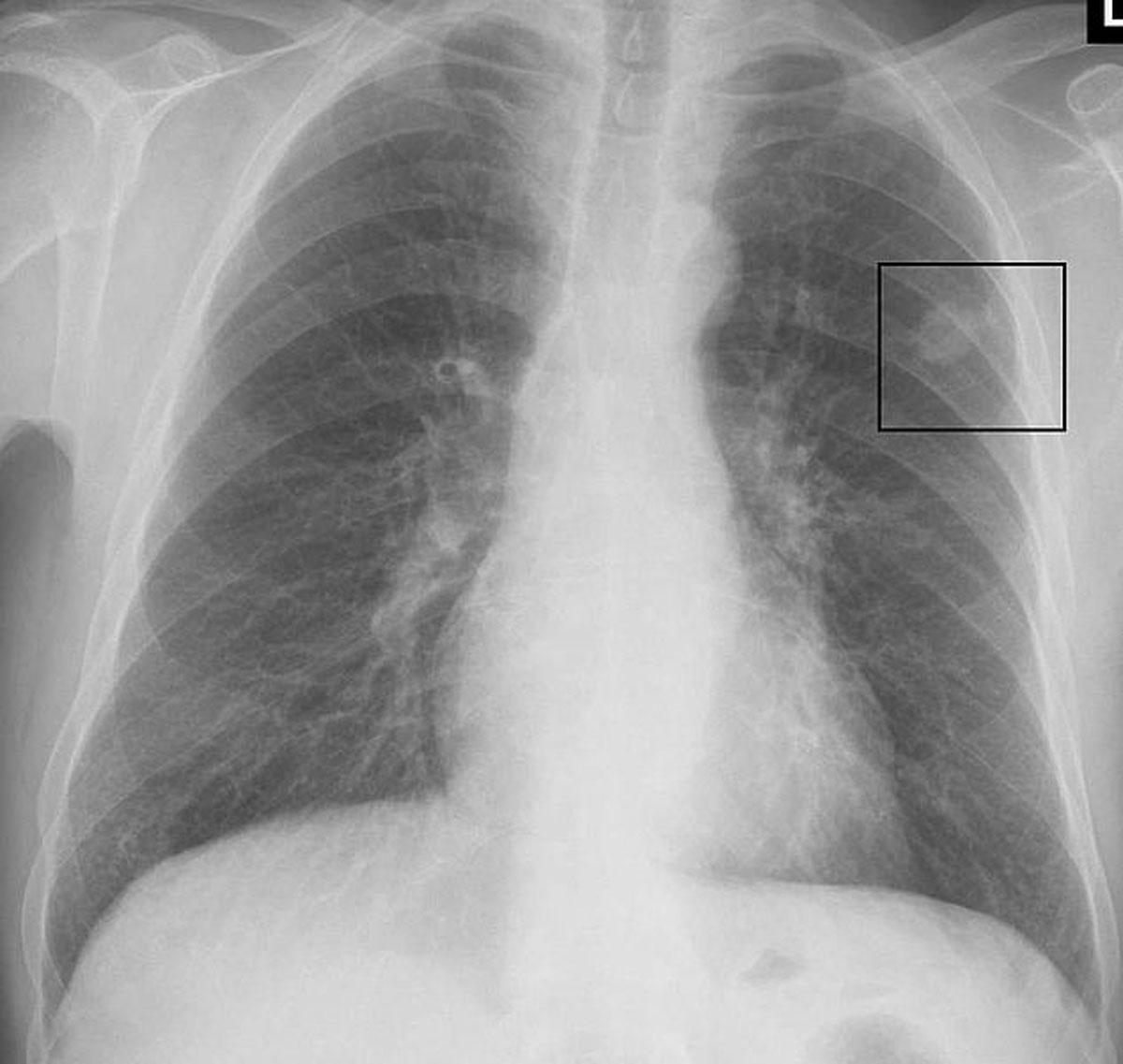 Radiografía de tórax mostrando un tumor canceroso en el pulmón izquierdo.