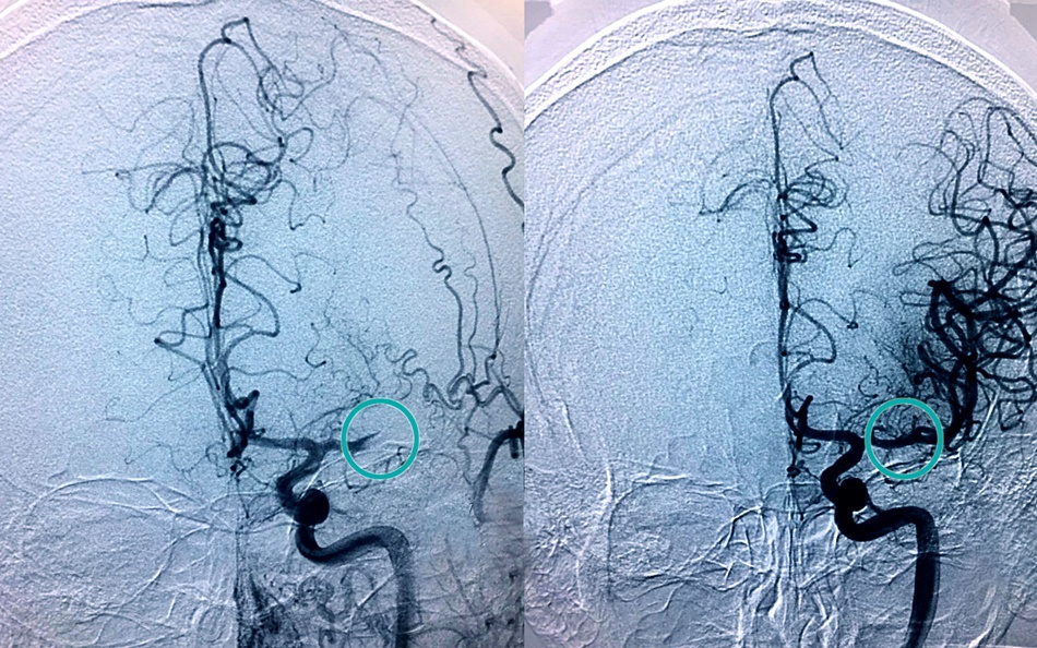 Imagen del vaso obstruido (izda.) y el vaso desobstruido (dcha.) tras practicarse una trombectomía. 