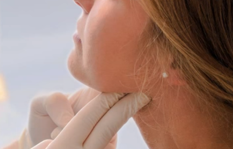 Detectar un lunar, bulto o mancha en la piel como alarma de cáncer de piel