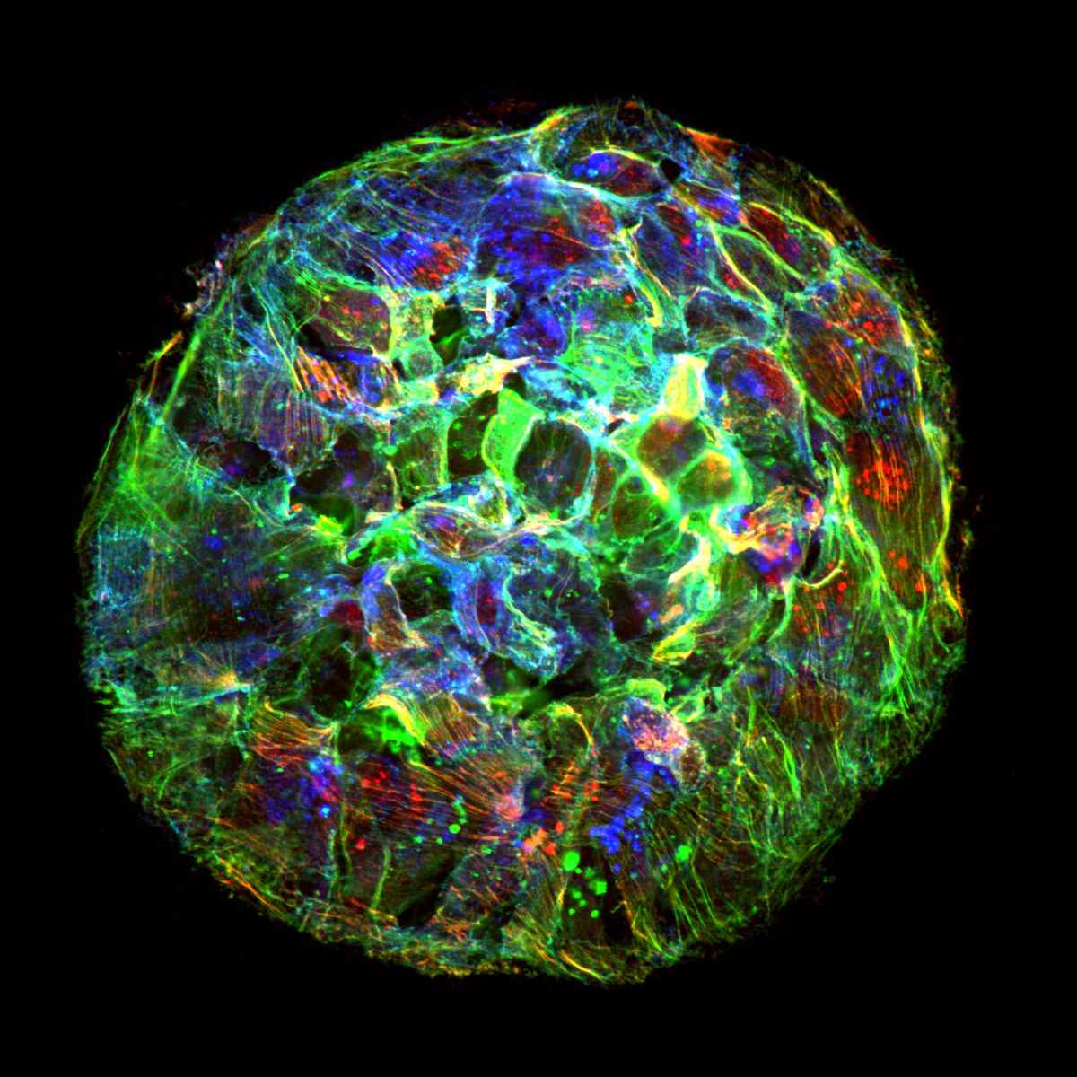 Conjunto de células de cáncer de mama adheridas a una superficie rica en colágeno. Se puede observar el citoesqueleto de actina en verde, revestido de miosina activa (ppMLC) en rojo, y las uniones célula-célula (E-cadherina) en azul. 