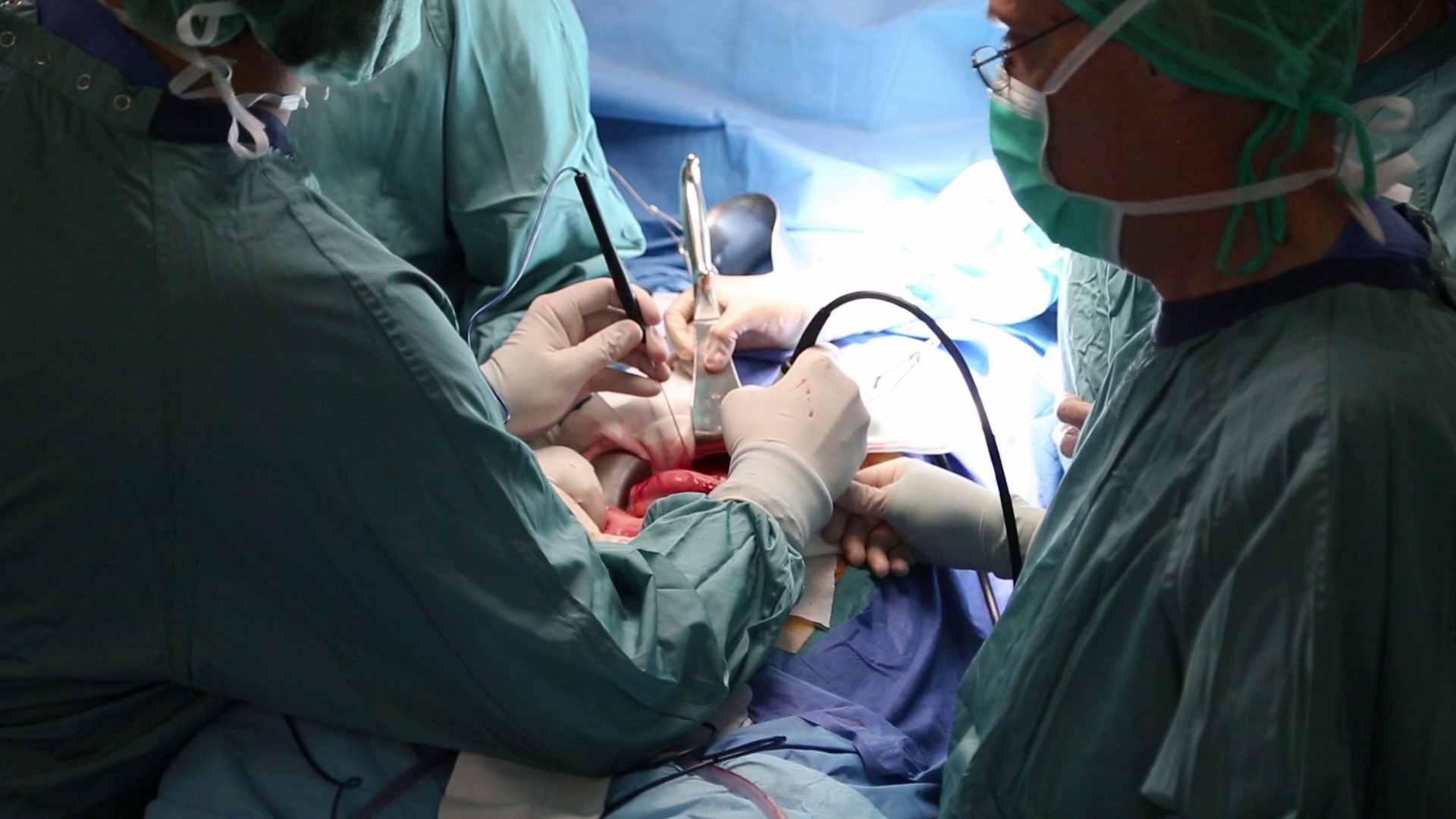 El hospital Vall d'Hebron ha practicado una cirugía innovadora en pacientes con un tipo de cáncer de páncreas hasta ahora inoperable