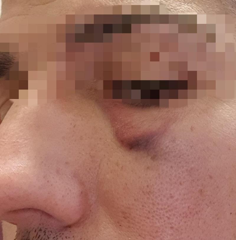 El resultado de los golpes en la cara a uno de los policías. Fuente SUP El resultado de los golpes en la cara a uno de los policías. Fuente SUP