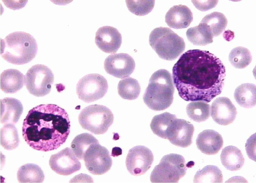 Neutrófilo y mileocito en un caso de Leucemia Mieloide Cronica CC