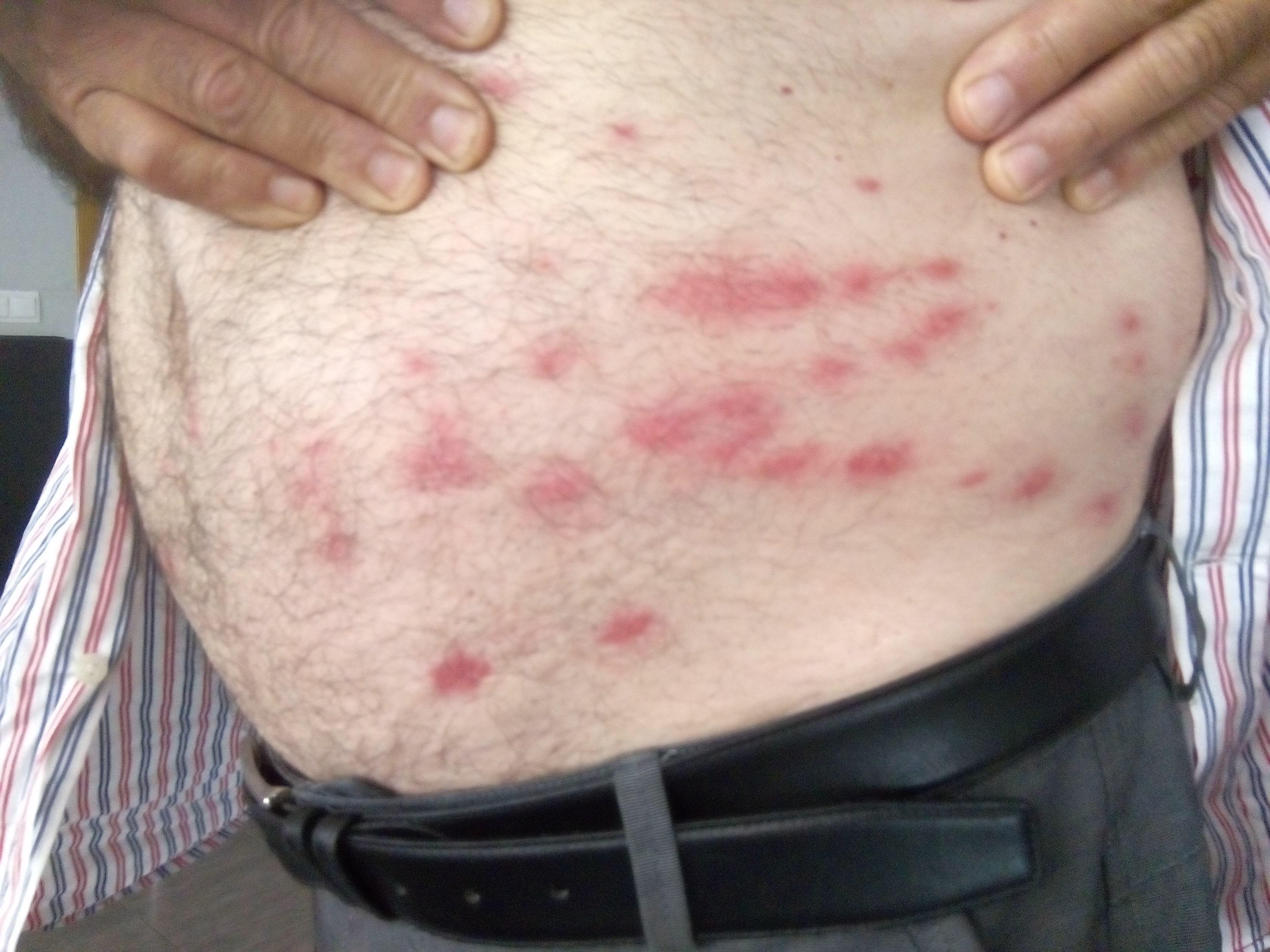EuropaPress 2242924 Picaduras de mosca en el cuerpo de un agricultor