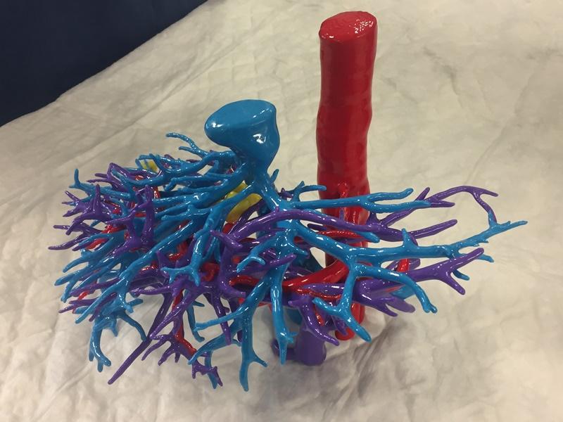Modelo físico impreso en 3D del hígado y lesiones concretas
