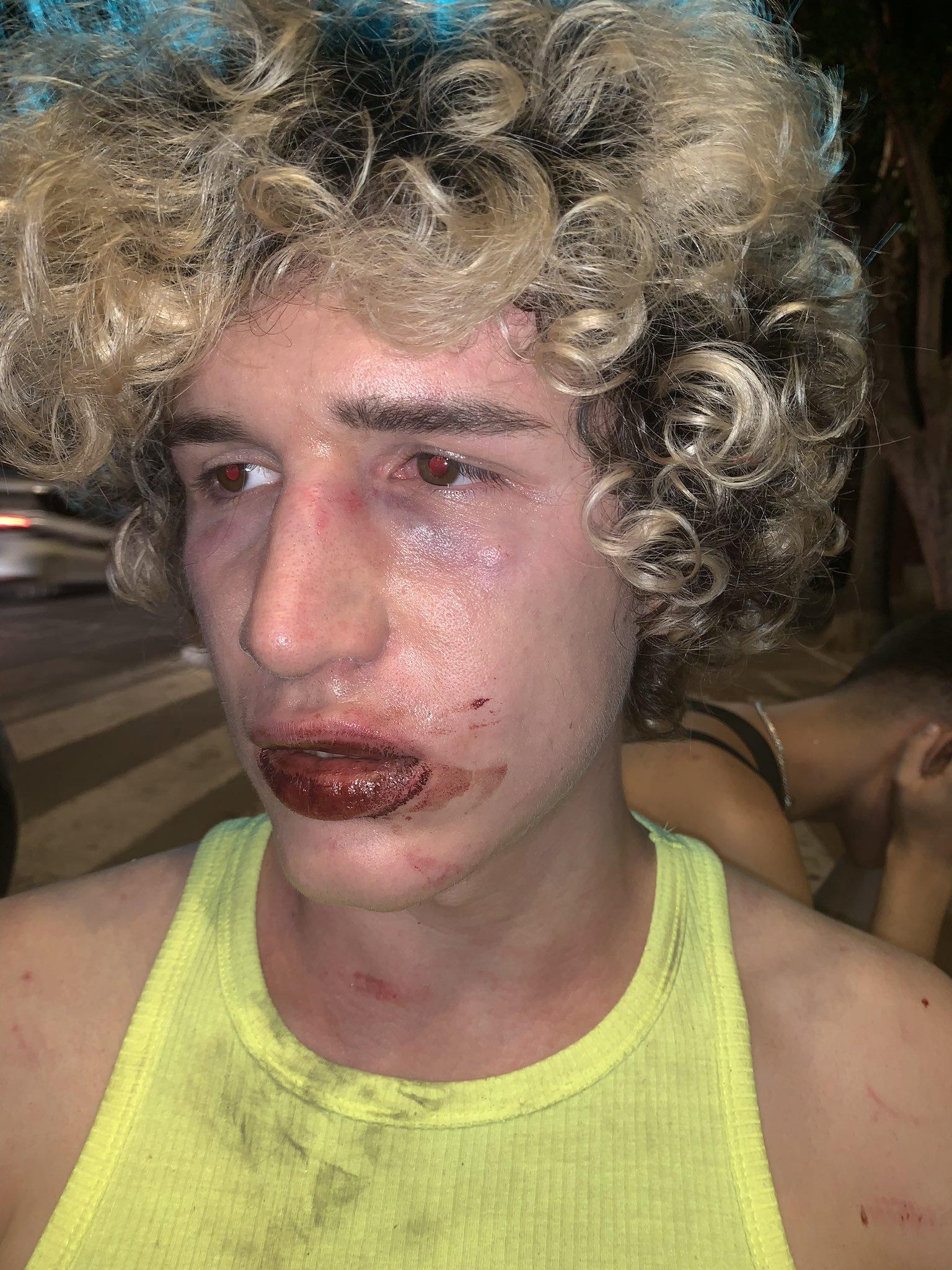 Un joven de nacionalidad italiana ha sido agredido en un ataque homófobo