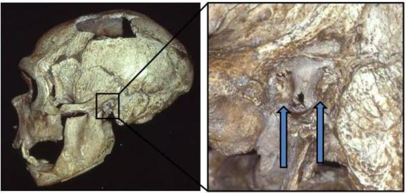 El cráneo de un hombre Neandertal con exóstosis (oído de nadador) / Erik Trinkaus