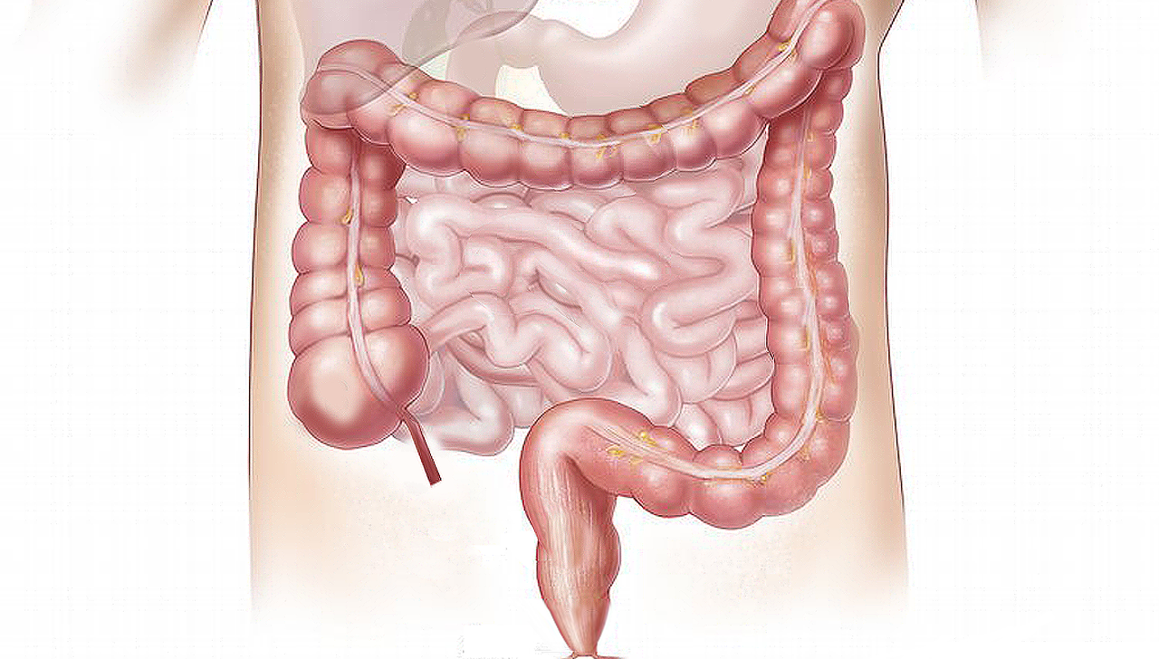 Cada vez son más los casos de cáncer colorrectal en población menor de 50 años.