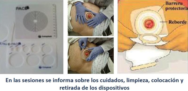 Escuela del Paciente Ostomizado Escuela del Paciente Ostomizado