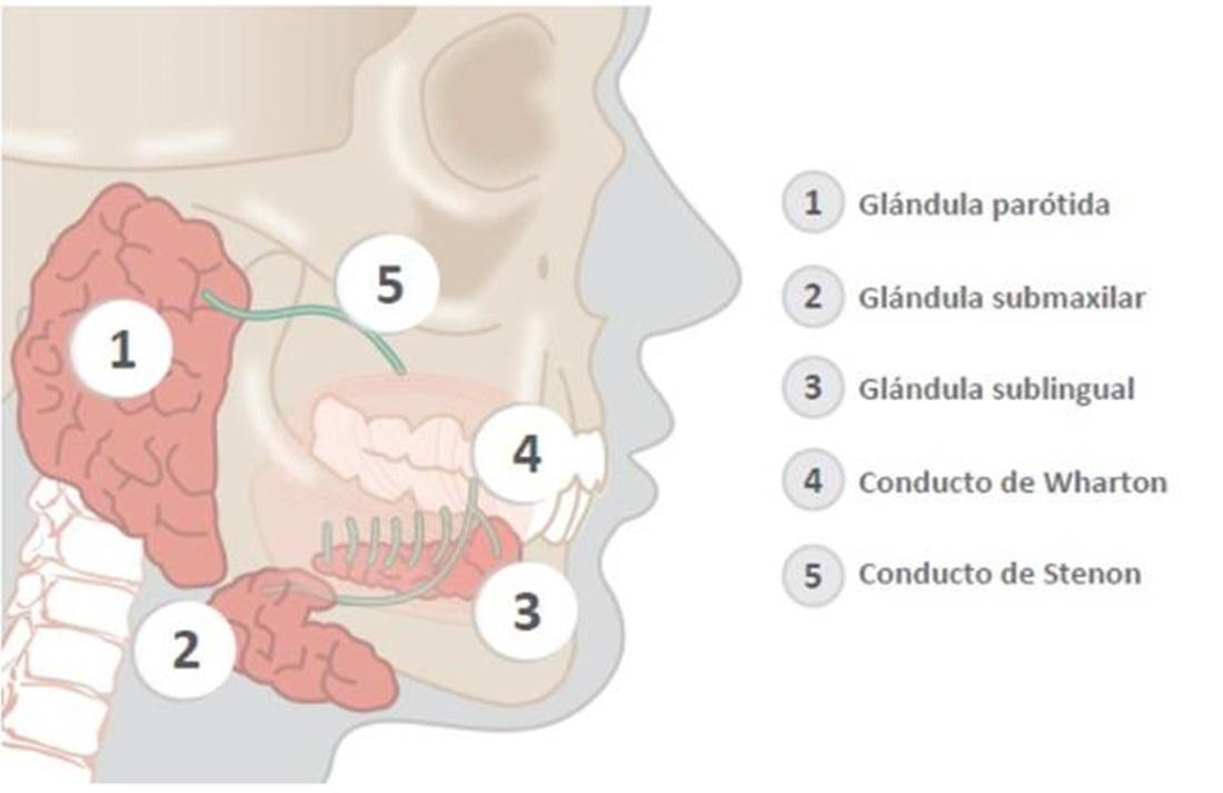 La sialoadenitis obstructiva crónica es la inflamación recurrente de las glándulas salivales.