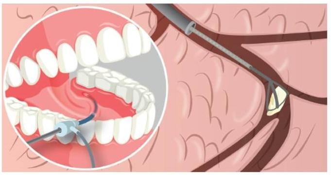 Sialoendoscopia