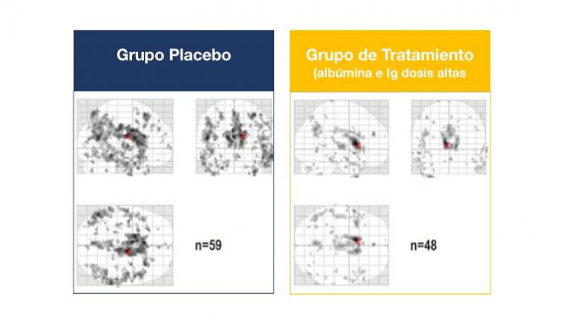 Cambios en el metabolismo de la glucosa cerebral en pacientes tratados con dosis altas de albúmina e inmunoglobulina (Ig) [derecha] respecto a placebo [izquierda].