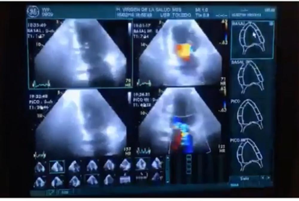 La ergoespirometría está recomendada prueba complementaria de primera elección en la prescripción de los programas de entrenamiento físico para la rehabilitación cardiorrespiratoria.