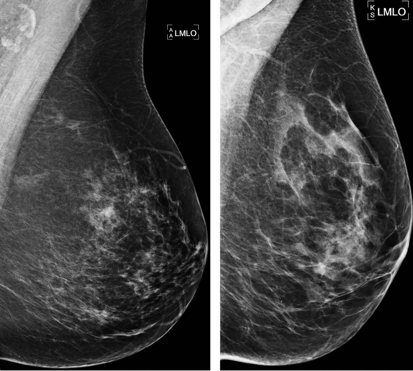 Ejemplos de mamografía. 